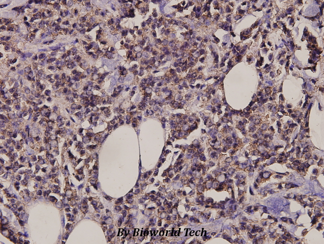 Immunohistochemistry (IHC) analyzes of MARK1/2/3/4 (N211) pAb in paraffin-embedded human breast carcinoma tissue at 1:100.