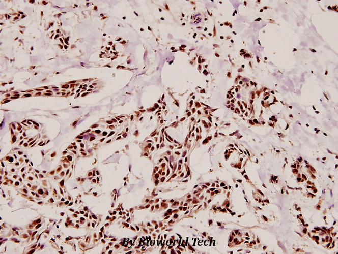 Immunohistochemistry (IHC) analyzes of Topo IIα (Q14) pAb in paraffin-embedded human breast carcinoma tissue at 1:100.