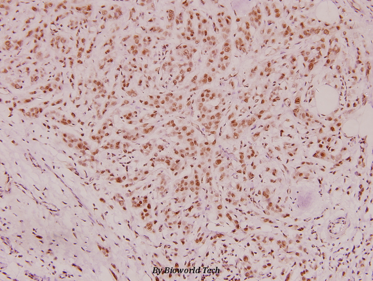Immunohistochemistry (IHC) analyzes of CD2BP2 (D124) pAb in paraffin-embedded human breast carcinoma tissue at 1:100.