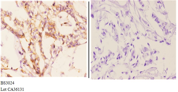 Immunohistochemistry (IHC) analyzes of CYP7B1 (Q127) pAb in paraffin-embedded human breast carcinoma tissue at 1:50.showing strong membranous and cytoplasmic staining. Negative control (the right)Using PBS instead of primary antibody, secondary antibody is Goat Anti-Rabbit IgG-biotin followed by avidin-peroxidase.