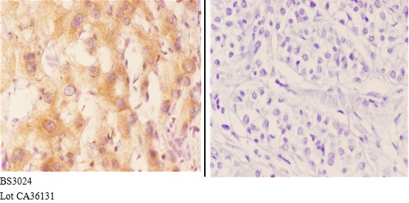 Immunohistochemistry (IHC) analyzes of CYP7B1 (Q127) pAb in paraffin-embedded human liver carcinoma tissue at 1:50.showing strong membranous and cytoplasmic staining. Negative control (the right)Using PBS instead of primary antibody, secondary antibody is