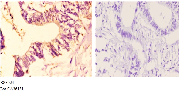 Immunohistochemistry (IHC) analyzes of CYP7B1 (Q127) pAb in paraffin-embedded human rectum carcinoma tissue at 1:50.showing strong membranous and cytoplasmic staining. Negative control (the right)Using PBS instead of primary antibody, secondary antibody i