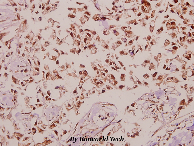Immunohistochemistry (IHC) analyzes of DnaJB4 (R120) pAb in paraffin-embedded human colorectal carcinoma tissue at 1:50.