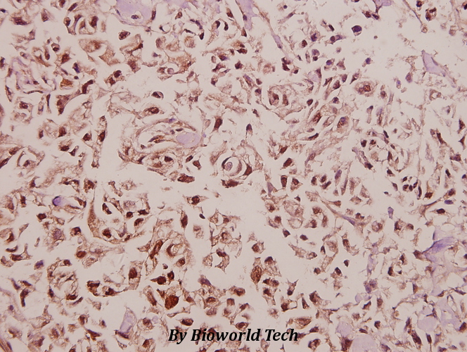 Immunohistochemistry (IHC) analyzes of IFI-56K (H63) pAb in paraffin-embedded human colorectal carcinoma tissue at 1:50.