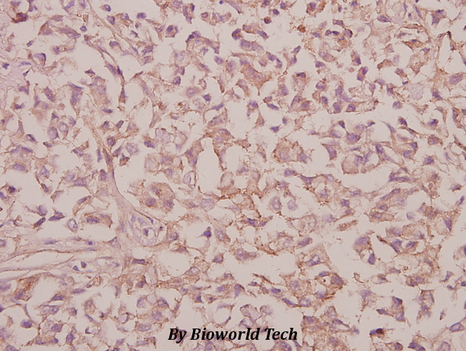 Immunohistochemistry (IHC) analyzes of RPS9 (E73) pAb in paraffin-embedded human colorectal carcinoma tissue at 1:50.