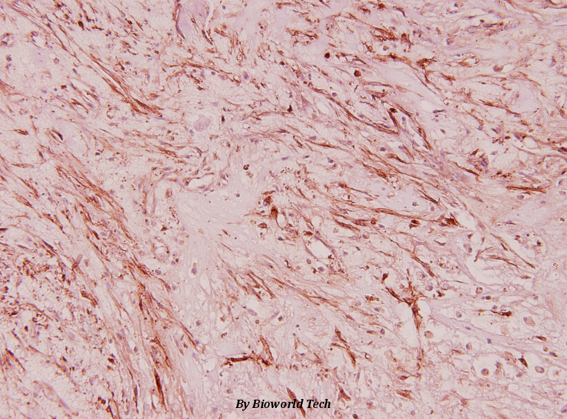 Immunohistochemistry (IHC) analyzes of RPL36 (V93) pAb in paraffin-embedded human breast carcinoma tissue at 1:100.