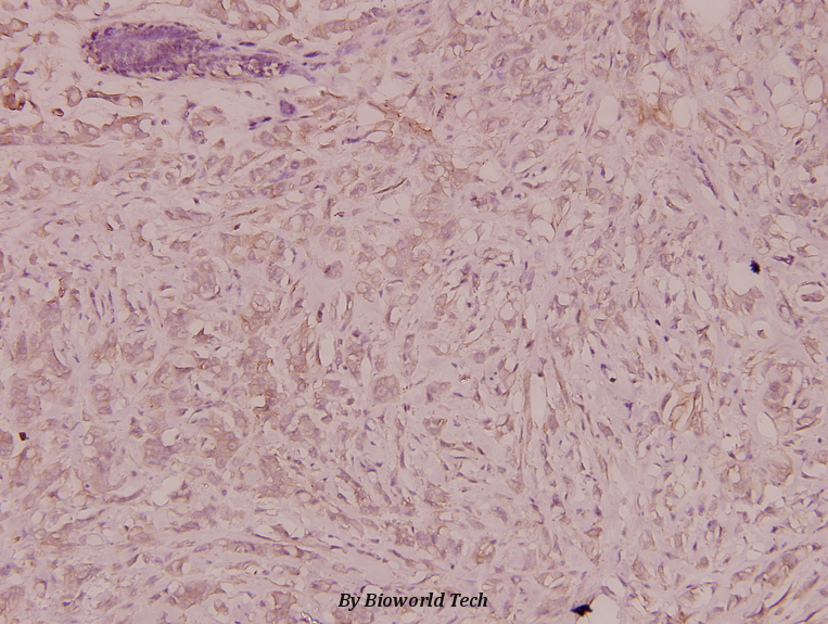 Immunohistochemistry (IHC) analyzes of ARF GAP1 (M204) pAb in paraffin-embedded human breast carcinoma tissue at 1:100.
