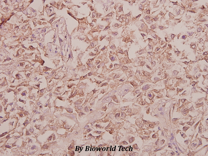 Immunohistochemistry (IHC) analyzes of Arylsulfatase F (Y341) pAb in paraffin-embedded human colorectal carcinoma tissue at 1:50.