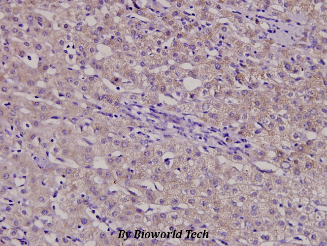Immunohistochemistry (IHC) analyzes of β-1,4-Gal-T3 (F304) pAb in paraffin-embedded liver cancer tissue at 1:100.