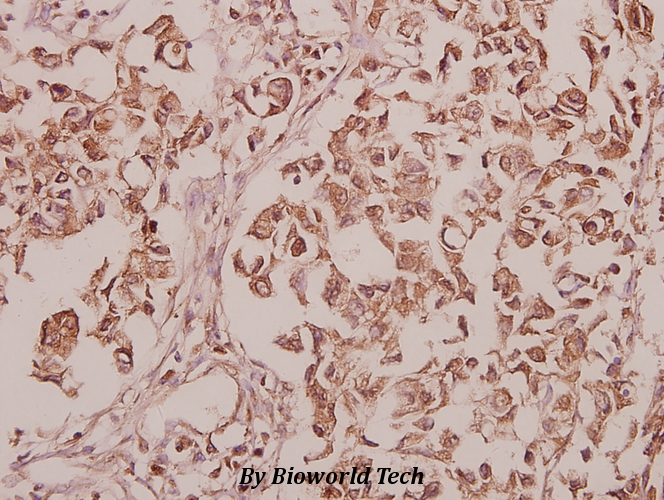 Immunohistochemistry (IHC) analyzes of CEP135 (H1117) pAb in paraffin-embedded human colorectal carcinoma tissue at 1:50.
