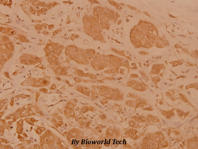 Immunohistochemistry (IHC) analyzes of Cerebral 1 (L310) pAb in paraffin-embedded human breast carcinoma tissue at 1:100.