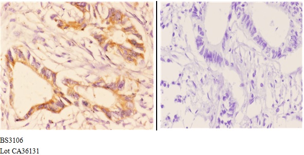 Immunohistochemistry (IHC) analyzes of CHSY2 (R671) pAb in paraffin-embedded human rectum carcinoma tissue at 1:50.showing moderate cytoplasmic and membranous staining. Negative control (the right)Using PBS instead of primary antibody, secondary antibody is Goat Anti-Rabbit IgG-biotin followed by avidin-peroxidase.