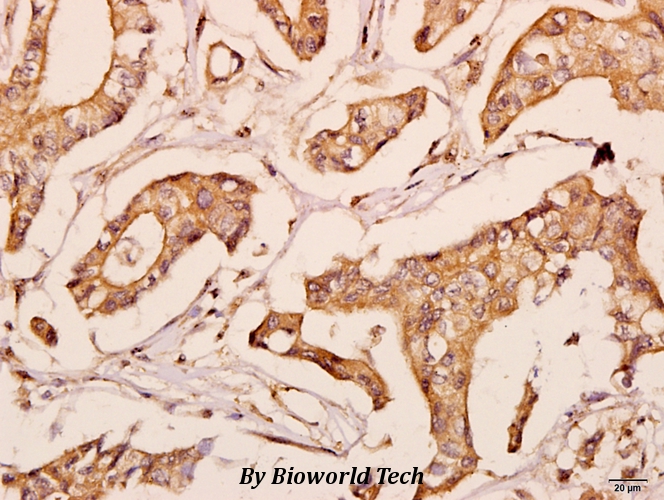 Immunohistochemistry (IHC) analyzes of POLR2E (L58) pAb in paraffin-embedded human breast carcinoma tissue at 1:50.