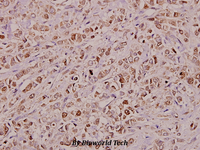 Immunohistochemistry (IHC) analyzes of KDEL Receptor 2 (L119) pAb in paraffin-embedded human breast carcinoma tissue at 1:100.