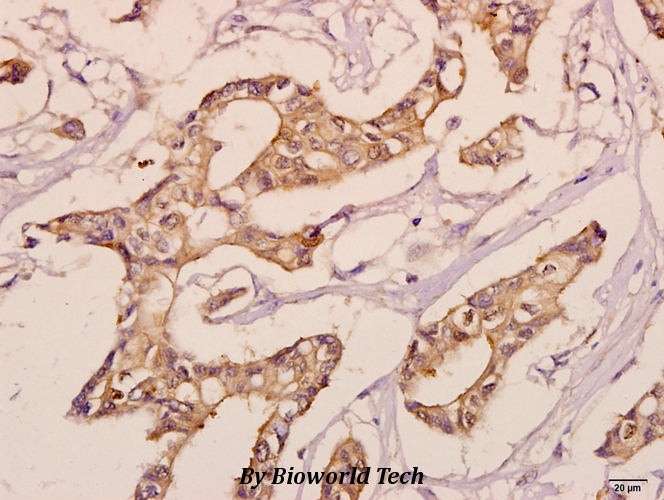Immunohistochemistry (IHC) analyzes of KDEL Receptor 3 (L95) pAb in paraffin-embedded human breast carcinoma tissue at 1:50.