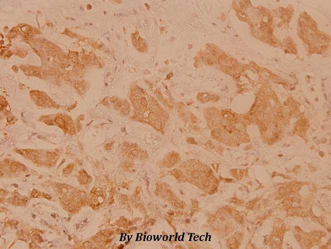 Immunohistochemistry (IHC) analyzes of HLA-DOα (V111) pAb in paraffin-embedded human breast carcinoma tissue at 1:100.