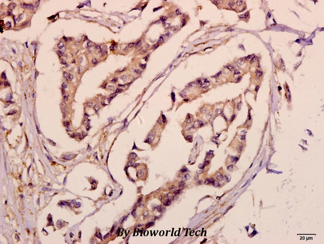 Immunohistochemistry (IHC) analyzes of ACSL6 (D531) pAb in paraffin-embedded human breast carcinoma tissue at 1:50.
