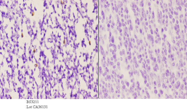 Immunohistochemistry (IHC) analyzes of VPAC1 (V371) pAb in paraffin-embedded human tonsil carcinoma tissue at 1:50.showing cytoplasmic staining. Negative control (the right)Using PBS instead of primary antibody, secondary antibody is Goat Anti-Rabbit IgG-biotin followed by avidin-peroxidase.