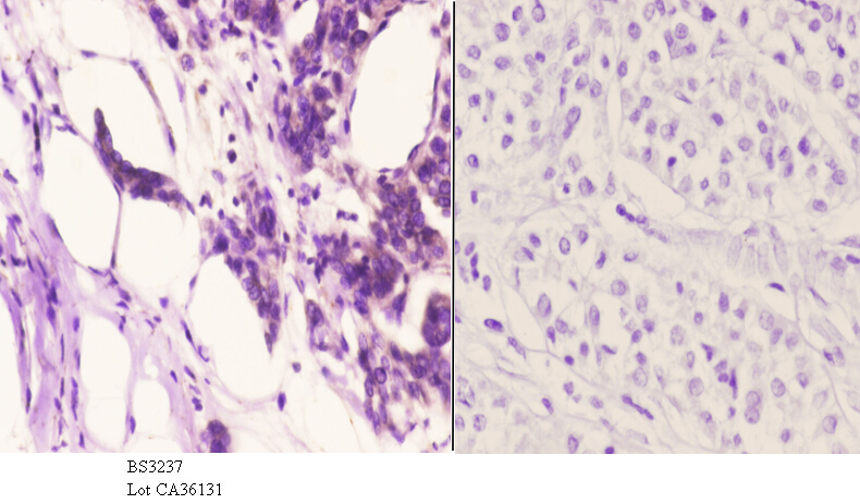 Immunohistochemistry (IHC) analyzes of TG1019 (R251) pAb in paraffin-embedded human liver carcinoma tissue at 1:50.showing cytoplasmic staining. Negative control (the right)Using PBS instead of primary antibody, secondary antibody is Goat Anti-Rabbit IgG-biotin followed by avidin-peroxidase.