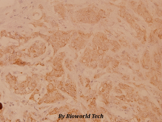 Immunohistochemistry (IHC) analyzes of POLR3A (P68) pAb in paraffin-embedded human breast carcinoma tissue at 1:100.