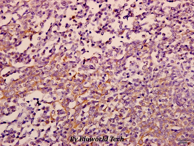Immunohistochemistry (IHC) analyzes of eIF3ε (V116) pAb in paraffin-embedded human tonsil carcinoma tissue at 1:50.