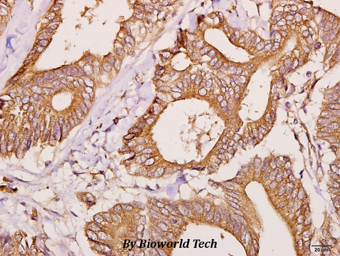 Immunohistochemistry (IHC) analyzes of FBP3 (R241) pAb in paraffin-embedded human colorectal carcinoma tissue at 1:50.