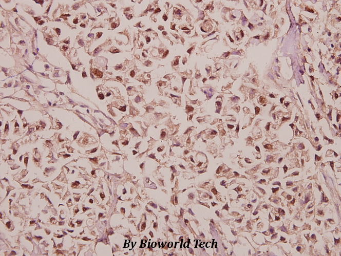 Immunohistochemistry (IHC) analyzes of GABAA Rγ1 (K51) pAb in paraffin-embedded human colorectal carcinoma tissue at 1:50.