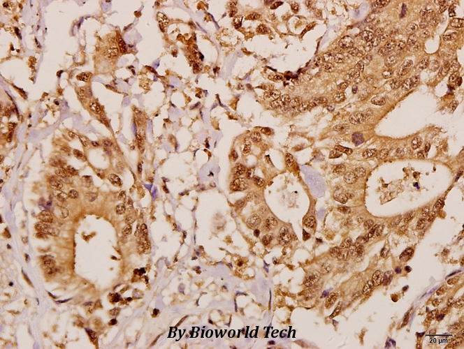 Immunohistochemistry (IHC) analyzes of GCP5 (I779) pAb in paraffin-embedded human colorectal carcinoma tissue at 1:50.
