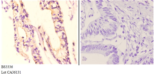 Immunohistochemistry (IHC) analyzes of NDUFA8 (P141) pAb in paraffin-embedded human colon carcinoma tissue at 1:50.showing strong cytoplasmic staining. Negative control (the right)Using PBS instead of primary antibody, secondary antibody is Goat Anti-Rabbit IgG-biotin followed by avidin-peroxidase.