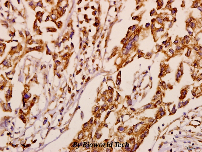 Immunohistochemistry (IHC) analyzes of Neuralized-1 (V250) pAb in paraffin-embedded human breast carcinoma tissue at 1:50.