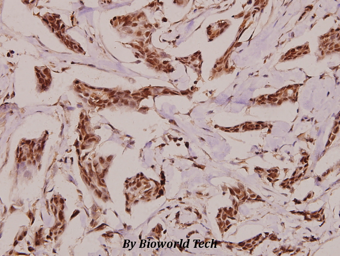 Immunohistochemistry (IHC) analyzes of VGF (K458) pAb in paraffin-embedded human breast carcinoma tissue at 1:100.