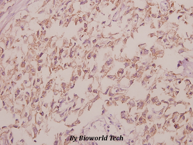 Immunohistochemistry (IHC) analyzes of Cdc40 (S209) pAb in paraffin-embedded human colorectal carcinoma tissue at 1:50.