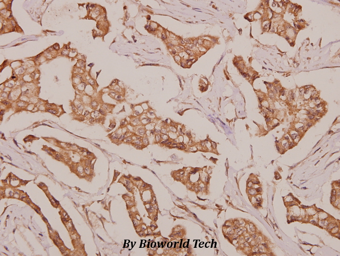 Immunohistochemistry (IHC) analyzes of DDX52 (V584) pAb in paraffin-embedded human breast carcinoma tissue at 1:50.