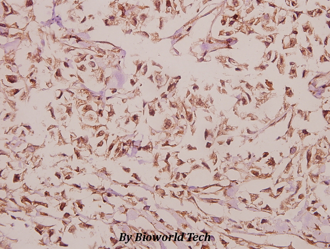 Immunohistochemistry (IHC) analyzes of Arrdc4 (E159) pAb in paraffin-embedded human colorectal carcinoma tissue at 1:50.