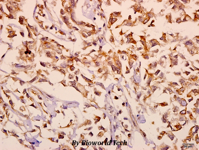 Immunohistochemistry (IHC) analyzes of mGluR-2/3 (N867)pAb in paraffin-embedded human breast carcinoma tissue at 1:50.