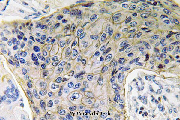 Immunohistochemistry (IHC) analyzes of AQP4 (P253) pAb in paraffin-embedded human lung carcinoma tissue.