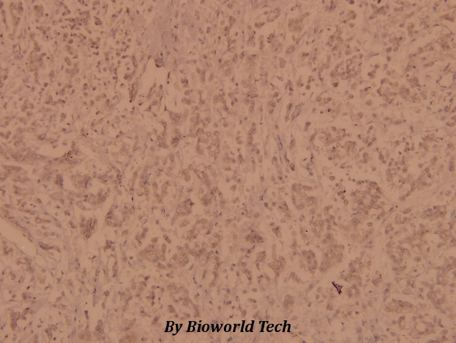 Immunohistochemistry (IHC) analyzes of FucT-IV (E71) pAb in paraffin-embedded human breast carcinoma tissue at 1:100.