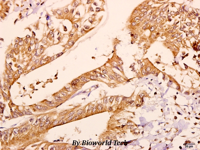 Immunohistochemistry (IHC) analyzes of CNPase (A108) pAb in paraffin-embedded human colorectal carcinoma tissue at 1:50.