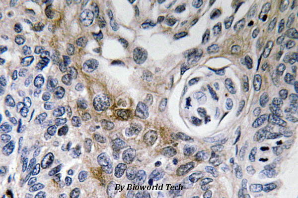 Immunohistochemistry (IHC) analyzes of CD63 (K156) pAb in paraffin-embedded human lung carcinoma tissue.