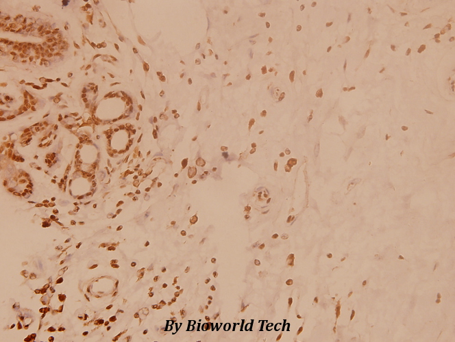 Immunohistochemistry (IHC) analyzes of BNIP-2 (E122) pAb in paraffin-embedded human breast carcinoma tissue at 1:100.