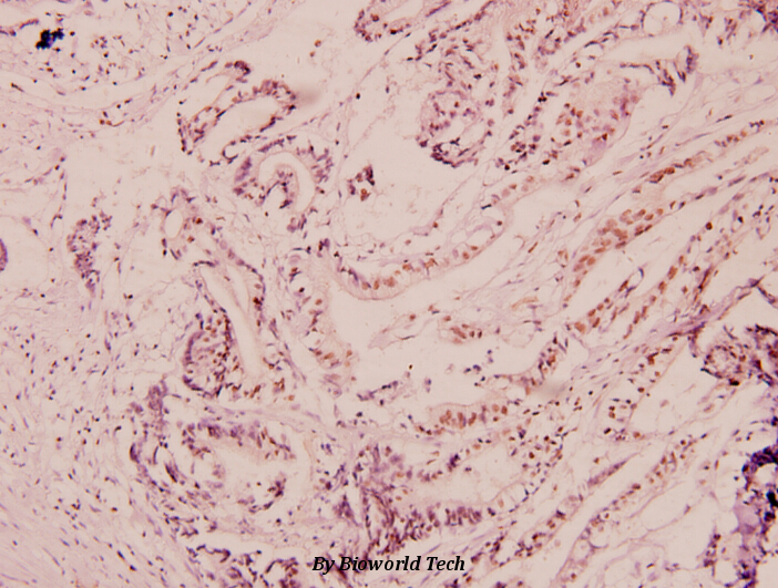 Immunohistochemistry (IHC) analyzes of NF-H (E972) pAb in paraffin-embedded human breast carcinoma tissue at 1:100.