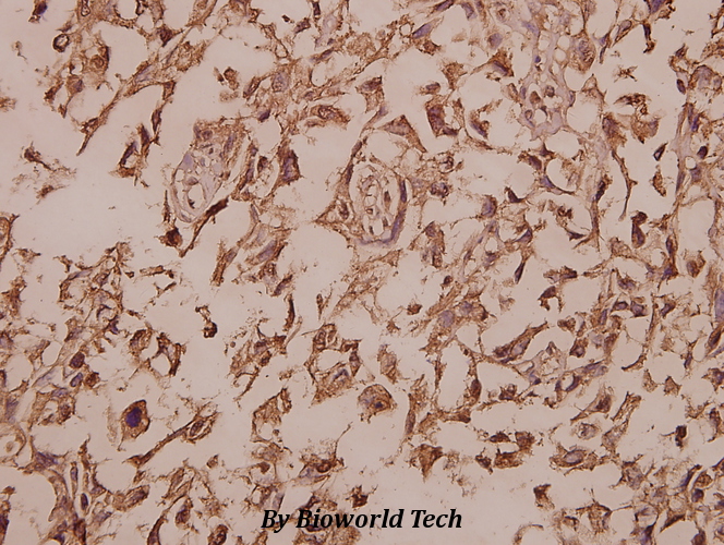Immunohistochemistry (IHC) analyzes of Cytokeratin 13 (E282) pAb in paraffin-embedded human colorectal carcinoma tissue at 1:50.