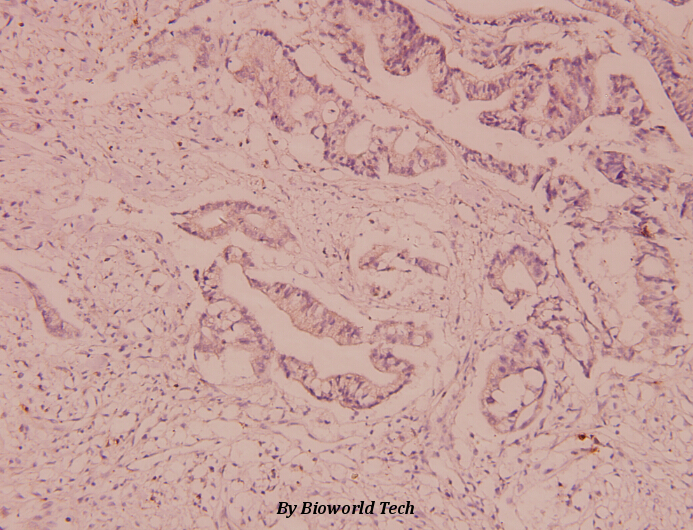 Immunohistochemistry (IHC) analyzes of P-glycoprotein 1 (I583) pAb in paraffin-embedded human colorectal cancer carcinoma tissue at 1:100.