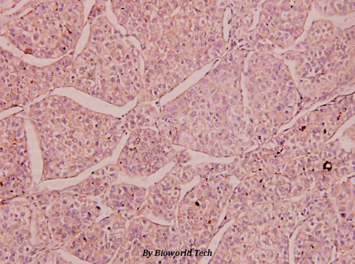 Immunohistochemistry (IHC) analyzes of NMDAε3 (P986) pAb in paraffin-embedded human liver carcinoma tissue at 1:100.