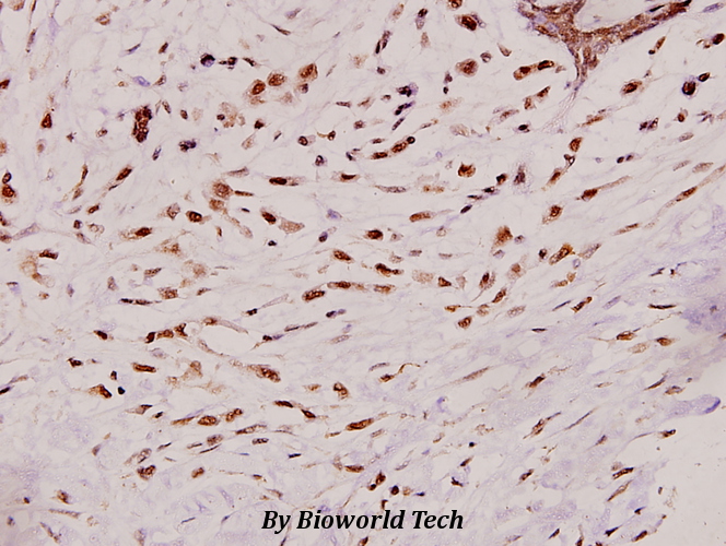 Immunohistochemistry (IHC) analyzes of Smad6 (N372) pAbb in paraffin-embedded human breast carcinoma tissue at 1:100.