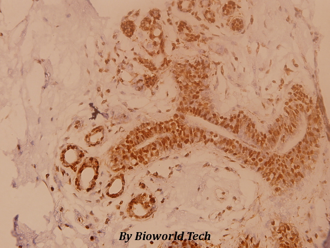 Immunohistochemistry (IHC) analyzes of Dok-1 (R392) pAb in paraffin-embedded human breast carcinoma tissue at 1:100.