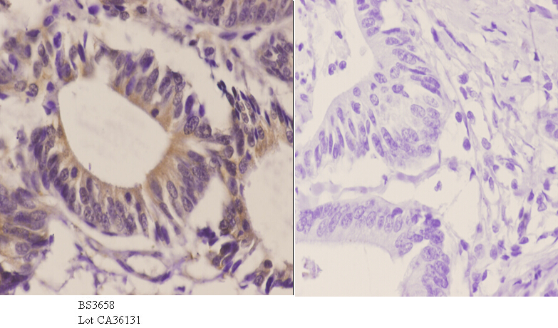 Immunohistochemistry (IHC) analyzes of GluR2 (Y873) pAb in paraffin-embedded human colon carcinoma tissue at 1:50.showing cell membrane staining. Negative control (the right)Using PBS instead of primary antibody, secondary antibody is Goat Anti-Rabbit IgG-biotin followed by avidin-peroxidase.