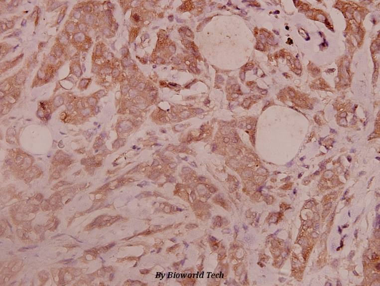 Immunohistochemistry (IHC) analyzes of Integrin β3 (S778) pAb in paraffin-embedded human breast carcinoma tissue at 1:100.