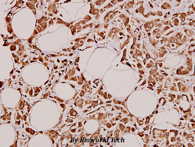 Immunohistochemistry (IHC) analyzes of GCS-α-1 (D423) pAb in paraffin-embedded human breast carcinoma tissue at 1:100.