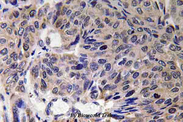 Immunohistochemistry (IHC) analyzes of Mfn2 (F403) pAb in paraffin-embedded human lung carcinoma tissue.